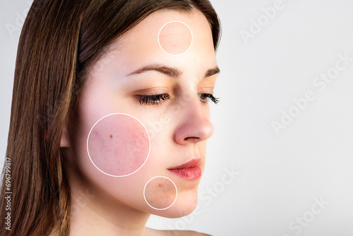 Female face with skin problems on gray background. Acne, wrinkles and enlarged pores. photo