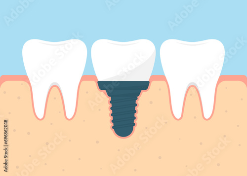 Dental prosthetics concept. Gums and dental implant flat vector illustration.