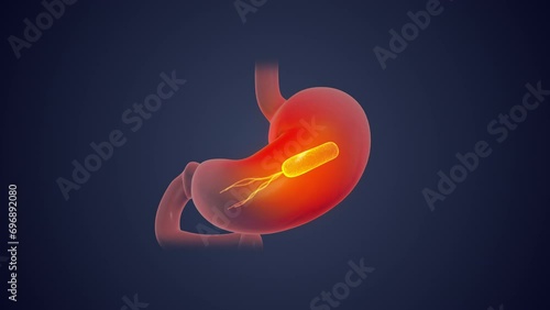 Helicobacter pylori in human stomach photo
