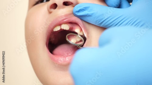 The doctor examines the oral cavity of a child with a missing tooth using a dental mirror. Healthcare and dental care concept. Slow motion. photo