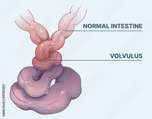 Bowel obstruction. Volvulus.  Intestine twists around itself. Infographic. Healthcare illustration. Vector illustration. 