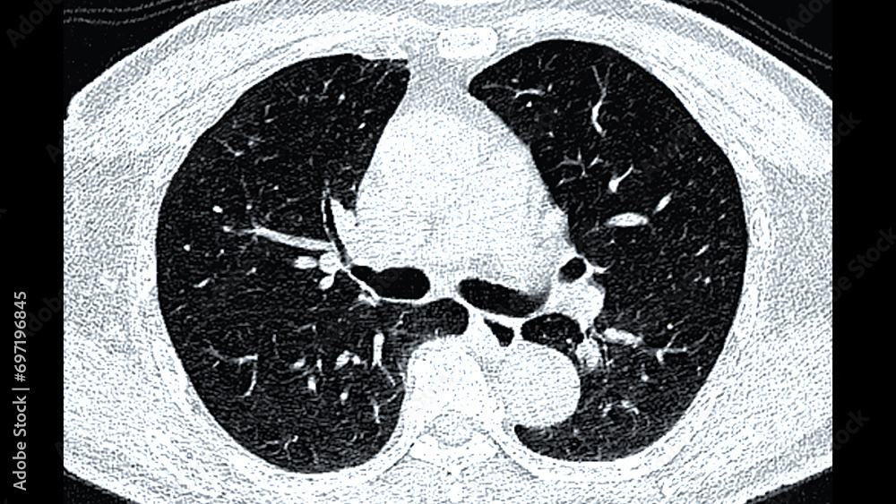 Ct Scan Of Chest Or Lung Axial View For Screening Lung Nodules Stock Ct Scan Of Chest Or Lung Axial View For Screening Lung Nodules Stock