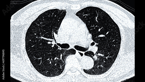 CT scan of Chest or lung  axial view for screening lung nodules