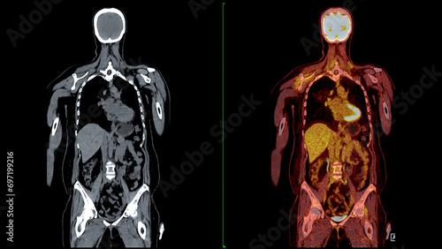 PET CT Scan fusion image It provides detailed images by merging