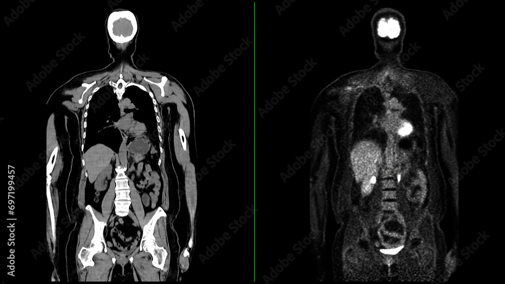 PET CT Scan fusion image It provides detailed images by merging - obrazy, fototapety, plakaty 