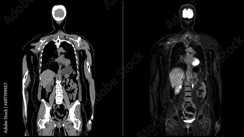 PET CT Scan fusion image It provides detailed images by merging photo