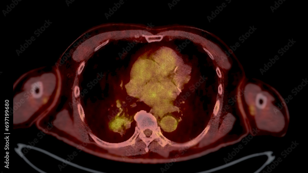 PET CT Scan fusion image It provides detailed images by merging Stock ...