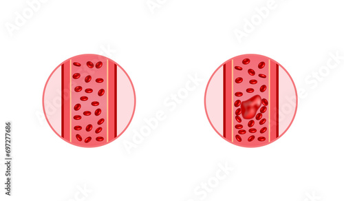 	
Thromboembolism. Circulating blood clot. Normal blood flow and a thrombus in blood flow, embolus. Red blood cells. Vector illustration.