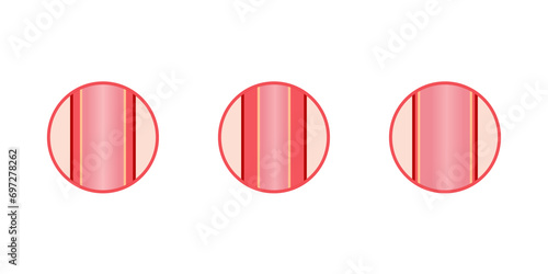 Arterial vasoconstriction and vasodilation. Cross section of arteries. Comparison of normal, constricted, and dilated blood vessels. Scientific Diagram. Vector illustration.