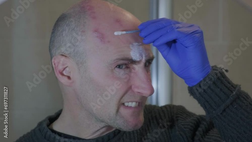 Man with painful shingles virus. Scabs and blisters on his face, head and above his eye. Reflection in bathroom mirror. Treating with calamine lotion. photo