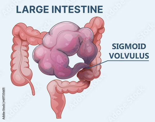 Bowel obstruction. Sigmoid volvulus. Healthcare illustration. Vector illustration. 