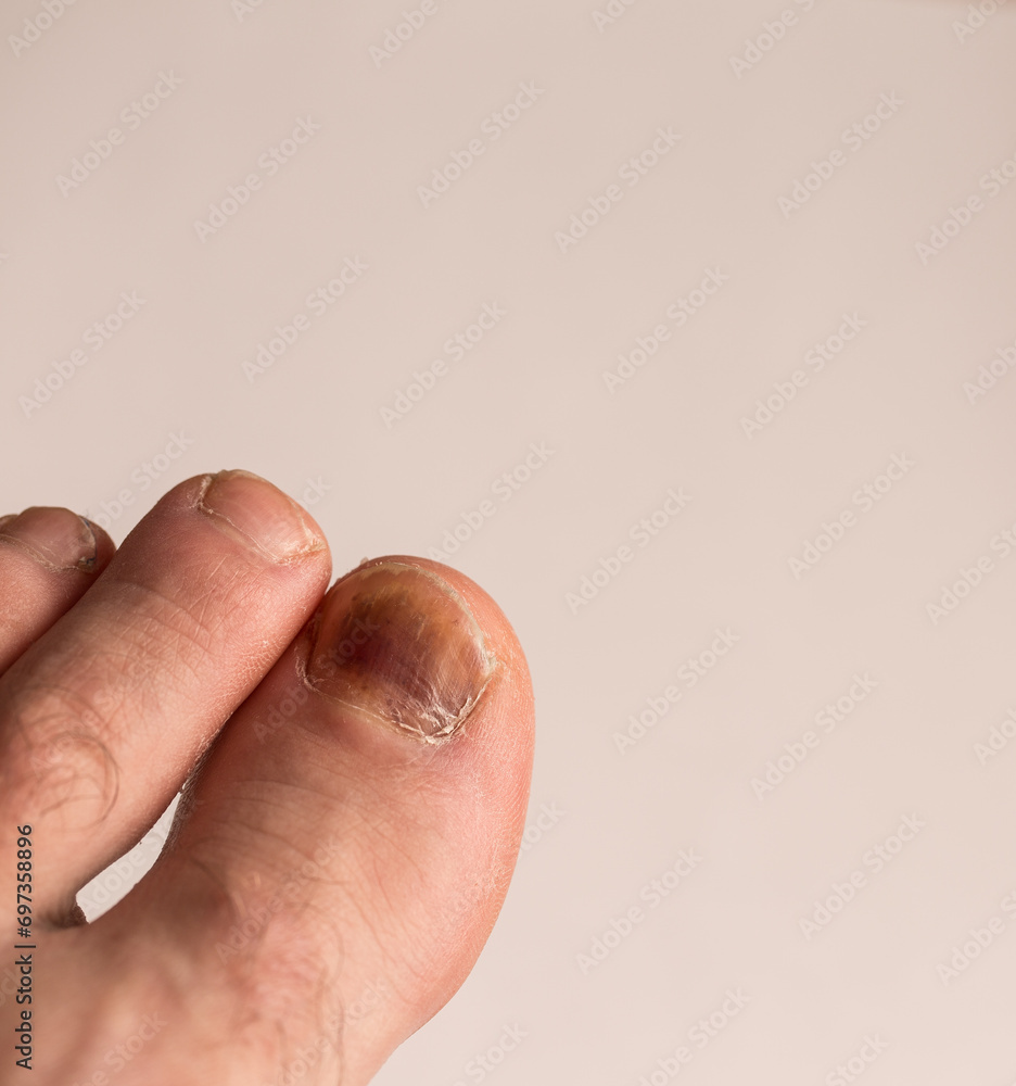 Injured finger with bruise, bruise on toe Injured finger with bruise, bruise on toe