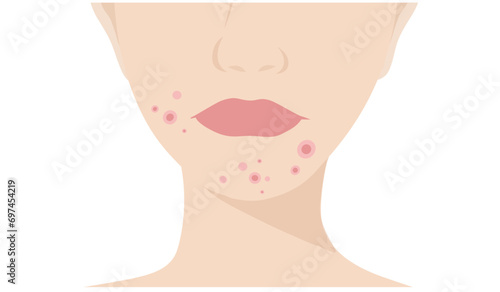 Young woman face with skin acne, pimples, blackheads vector illustration. Acne skin face problem concept