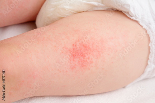 Allergic rash on the legs of the toddler baby boy. Red pimples from allergies on the child's body.