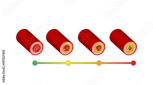  Atherosclerosis, normal artery versus narrowed artery blocked with cholesterol plaque. Blood vessel blocked with a clot. High cholesterol level as atherosclerotic risk. Vector illustration.