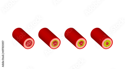 Atherosclerosis, normal artery versus narrowed artery blocked with cholesterol plaque. Blood vessel blocked with a clot. High cholesterol level as atherosclerotic risk. Vector illustration.