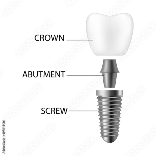 Dental implant. Realistic implant structure, graphic models of the crown. Screw prosthesis, orthodontic dental implantation
