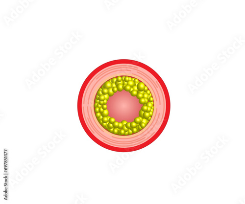 Hyperlipidemia, Atherosclerosis. Blood vessel blocked with a clot. High cholesterol level as atherosclerotic risk. ldl and hdl. Vector design.