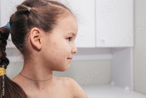 Obraz na plátně Portrait of a girl in profile with a rash on her cheek from chickenpox