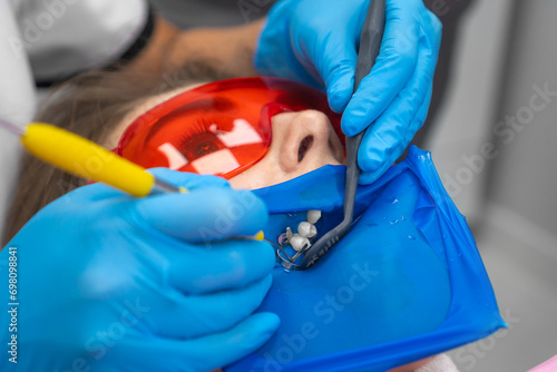 Close-up dentist's hands place the filling material into the patient's tooth with a dental spatula. Treatment, restoration of the chewing surface of the teeth of a young woman.