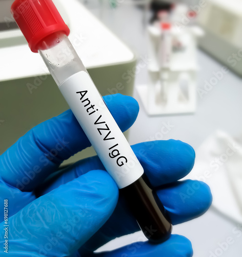 Blood sample for Anti varicella-zoster virus (VZV) IgG test. photo