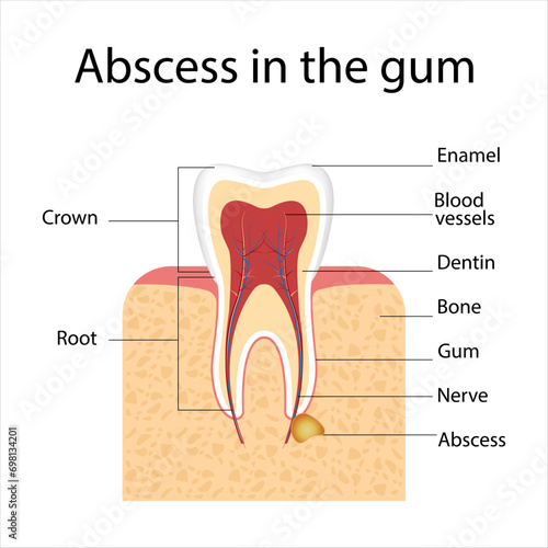 Abscess in the gum diagram