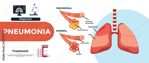 Pneumonia. Difference and Comparison of healthy lungs (bronchioles and alveoli) and pneumonia