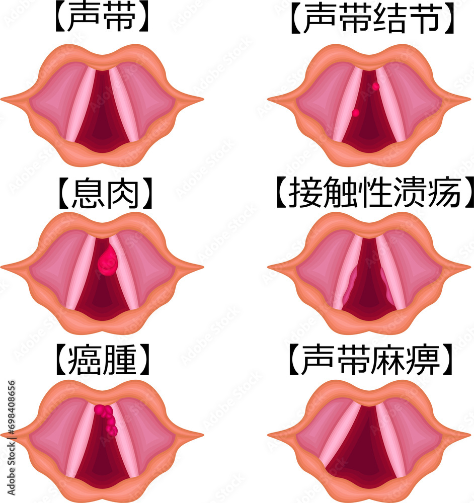 声帯 病気 種類 構造 イラスト 中国語 Stock Illustration | Adobe Stock