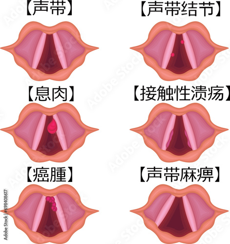 声帯　病気　種類　構造　イラスト　中国語