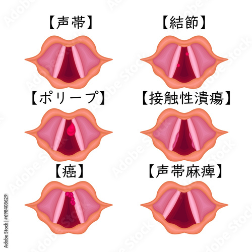 声帯　病気　種類　構造　イラスト　日本語