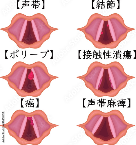 声帯　病気　種類　構造　イラスト　日本語