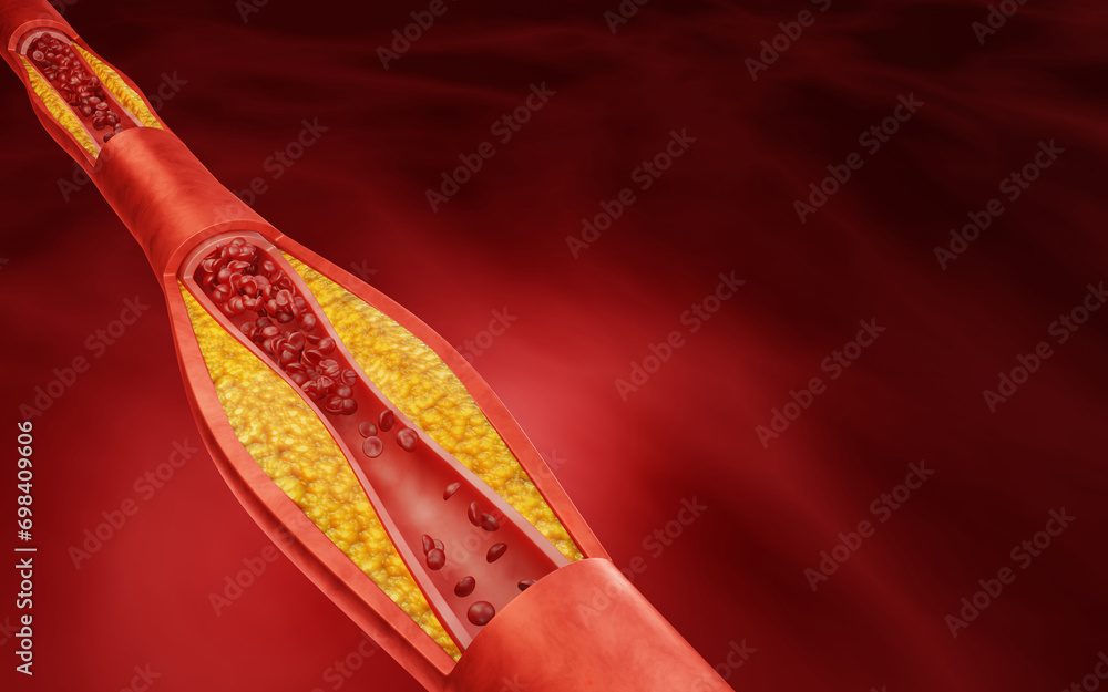 ภาพประกอบสต็อก Fat clogs the arteries in the body. LDL. low-density ...