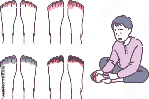 illustration of a person with frostbite on his foot