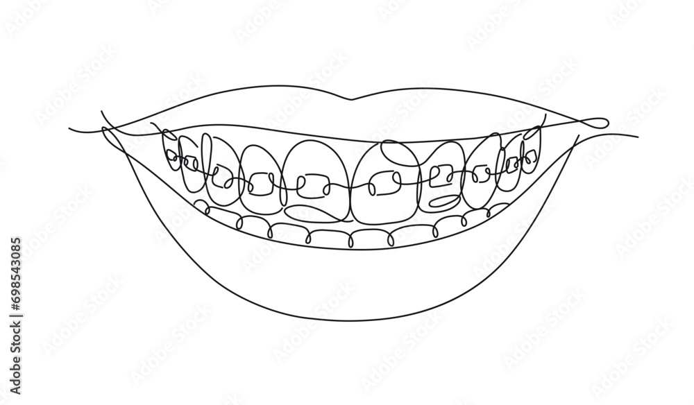 Smile with teeth braces in flat line style drawing on white background
