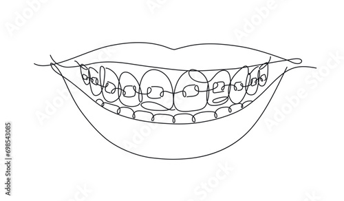 Obraz na płótnie Smile with teeth braces in flat line style drawing on white background w salonie