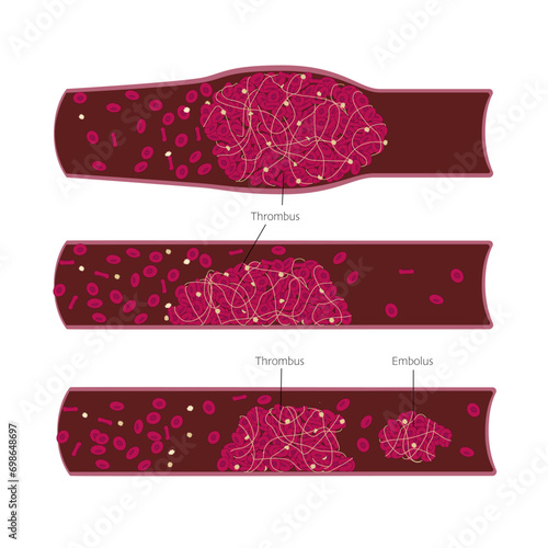 Different types of thrombus and embolus in the blood vessels closup illustration. Medical chart for science or education. Vector illustration photo