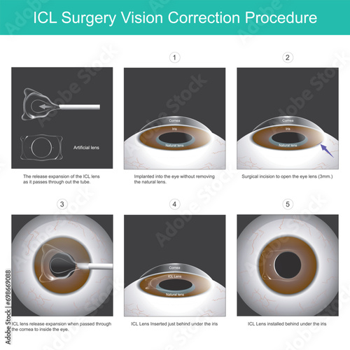 ICL Surgery Vision Correction Procedure. A new eye lens that can be implanted into the eye without removing the natural lens..