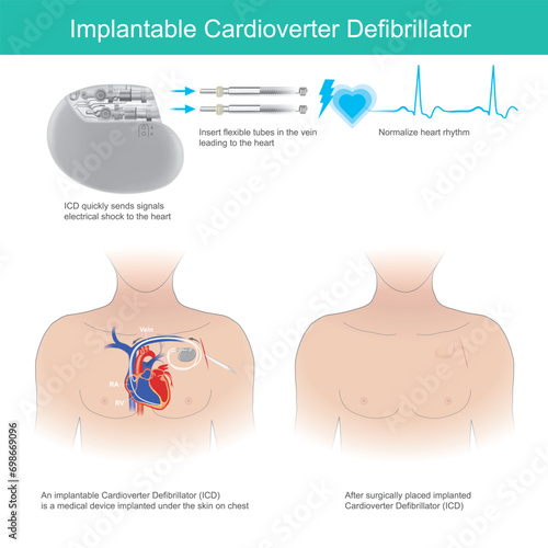 Implantable Cardioverter Defibrillator. Medical tool implanted under the skin use for quickly sends signals electrical shock to the heart.