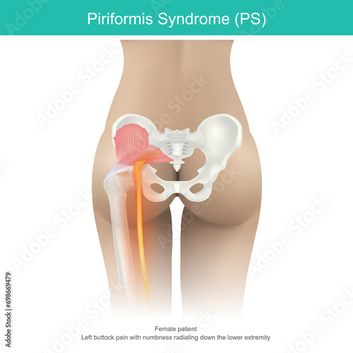 Piriformis syndrome. a condition in which nerve compression in the muscles, located in the buttock region causes buttocks pain and down to thigh in women..