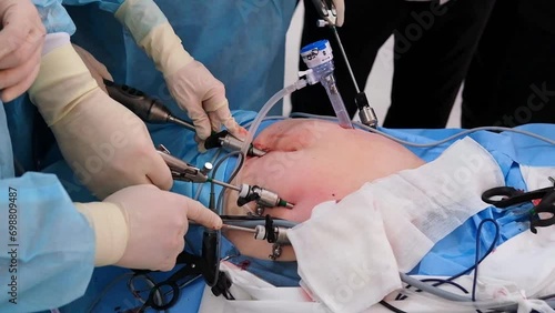 The surgeon does endoscopic surgery on the abdomen. The doctor performs arthroscopic surgery on the abdominal cavity in the operating room with arthroscopic instruments.  photo