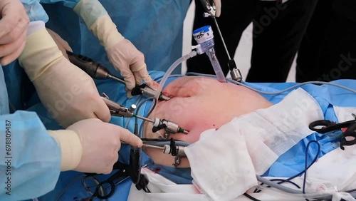 The surgeon does endoscopic surgery on the abdomen. The doctor performs arthroscopic surgery on the abdominal cavity in the operating room with arthroscopic instruments. 