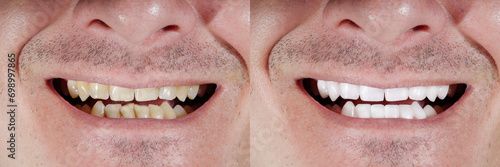 Collage of Man Tooth Before and After Professional Treatment of Dental Plaque, Closeup. Banner Design. Male Mouth Comparison of Tooth Whitening