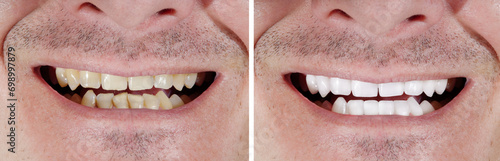 Teeth Whitening Before After and Ceramic Veneers Restoration For Perfect Natural Smile. Dental Сare and Stomatology. Man's Portrait for Dentistry. Male Mouth Comparison