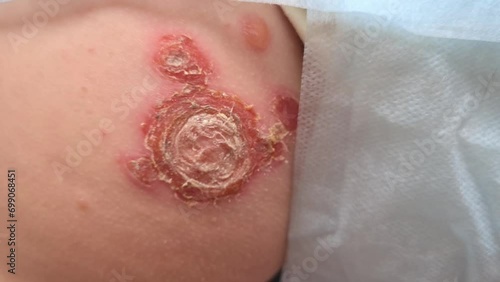 Psoriasis is an autoimmune disease affects skin causing skin to become inflamed and red and scaly. Shingles and herpis photo