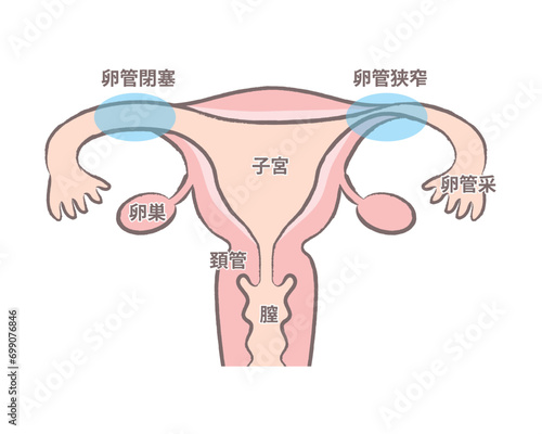 卵管閉塞 卵管狭窄　卵管のつまり　子宮のイラスト説明図