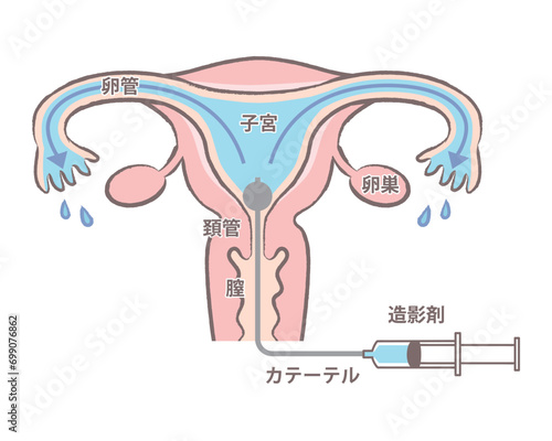 卵管造影検査の様子　卵管の通りが良い子宮のイラスト　説明図　文字あり