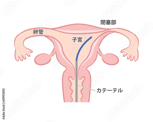 卵管鏡下卵管形成術　子宮のイラスト　