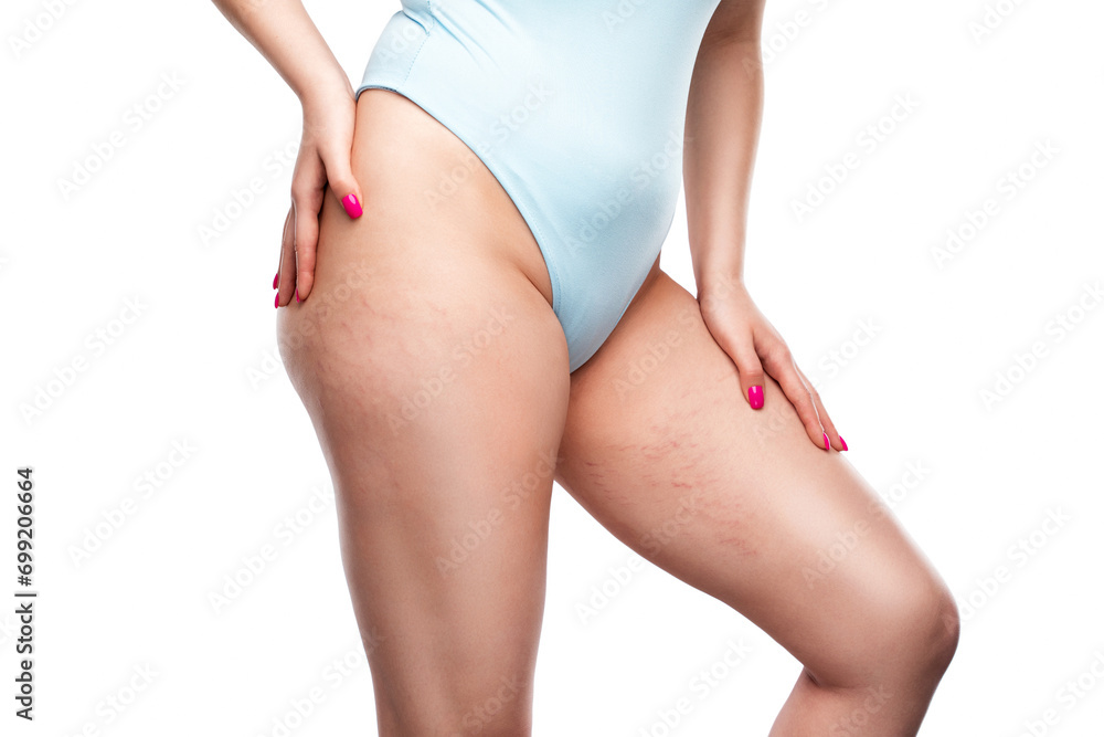 A woman after weight loss shows stretch marks on the skin of her legs and the outer and inner side of the thighs. Treatment of skin stretch marks in the clinic.