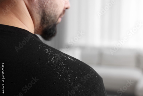 Man with dandruff on his sweater indoors, closeup. Space for text photo
