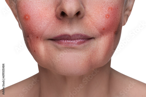 Woman with rosacea on white background, closeup. Problem skin treatment